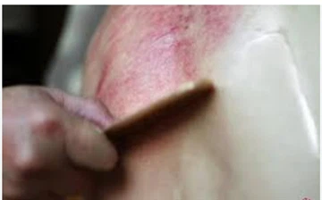 Ako sa vysporiadať s poškodenou pokožkou počas Gua Sha?